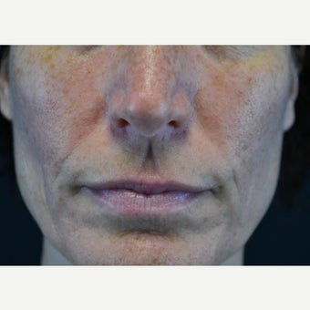 45-54 year old woman treated with Restylane before 2255607
