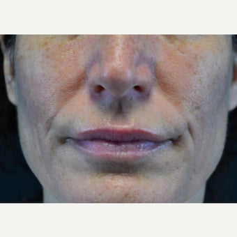 45-54 year old woman treated with Restylane after 2255607