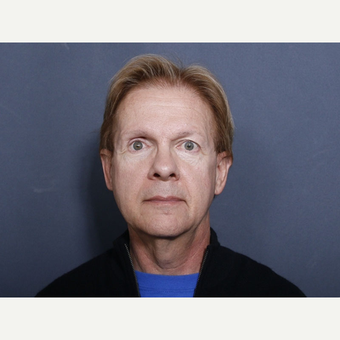 55-64 year old man treated with Neck Lift (view 1 of 2) before 3175845