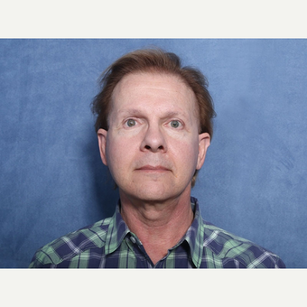 55-64 year old man treated with Neck Lift (view 1 of 2) after 3175845
