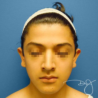 Otoplasty before 864913