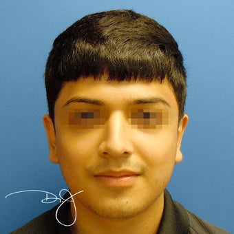 Otoplasty after 864913