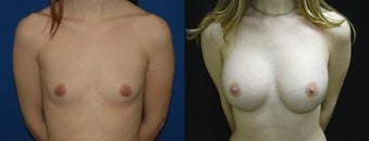 30 year old woman treated with Breast Augmentation before 2990473