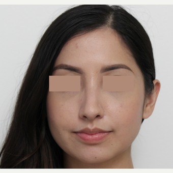 18-24 year old woman treated with Rhinoplasty after 3366365