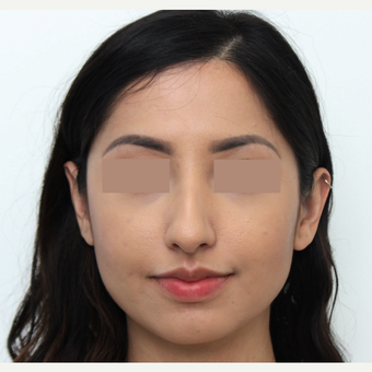 18-24 year old woman treated with Rhinoplasty before 3366365