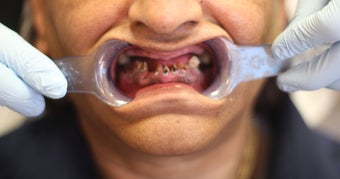 All-on-4 Dental Implants before 1288255