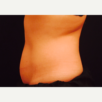 25-34 year old woman treated with CoolSculpting before 3747776