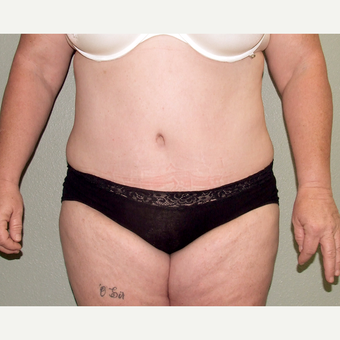45-54 year old woman treated with Tummy Tuck after 3191829