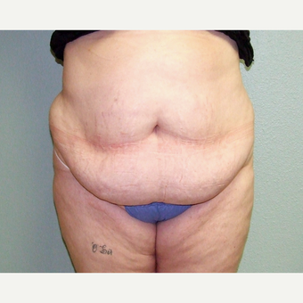45-54 year old woman treated with Tummy Tuck before 3191829