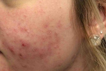 25-34 year old woman treated with Chemical Peel before 3246066