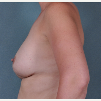 35 Year Old woman with breast implant revision before 3617098