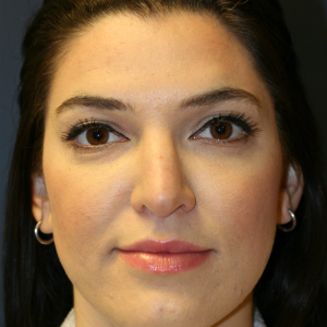 25-34 year old woman treated with Rhinoplasty before 3559810