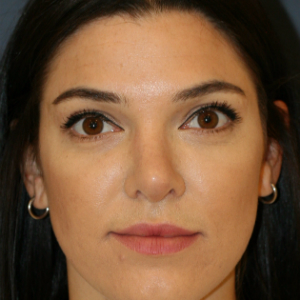 25-34 year old woman treated with Rhinoplasty after 3559810
