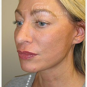 41 year old woman with MACS facelift (mini facelift) 1606889