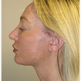 41 year old woman with MACS facelift (mini facelift) after 1606889