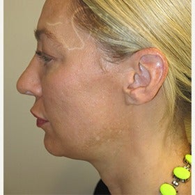 41 year old woman with MACS facelift (mini facelift) before 1606889
