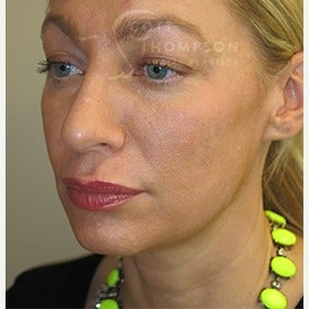 41 year old woman with MACS facelift (mini facelift) 1606889