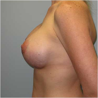 27 year old woman treated with Breast Augmentation after 3468227