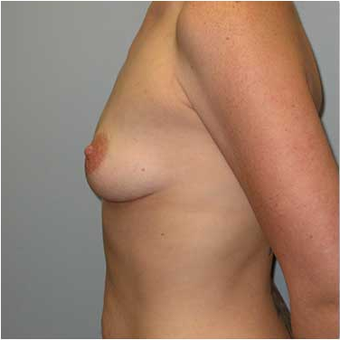 27 year old woman treated with Breast Augmentation before 3468227