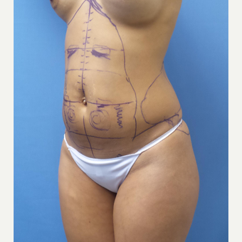 35-44 year old woman treated with Smart Lipo before 3097224
