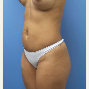 35-44 year old woman treated with Smart Lipo after 3097224