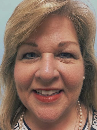 57 year old patient after first Kybella treatment. 2718501