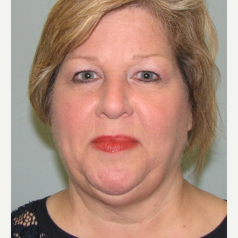 57 year old patient after first Kybella treatment. before 2718501