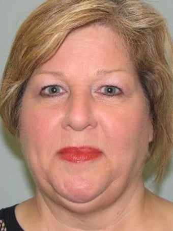 57 year old patient after first Kybella treatment. 2718501