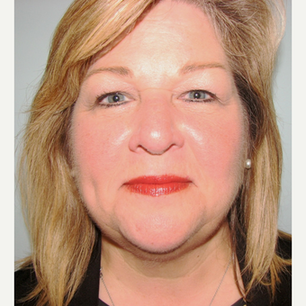 57 year old patient after first Kybella treatment. after 2718501