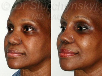 Female African American Revision Rhinoplasty after 1384591