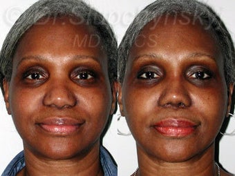 Female African American Revision Rhinoplasty before 1384591