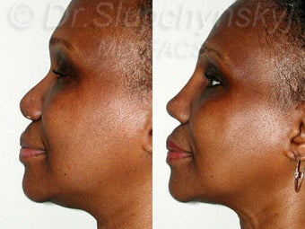 Female African American Revision Rhinoplasty 1384591