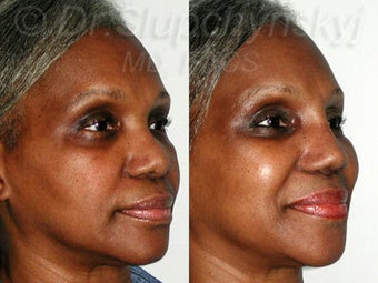 Female African American Revision Rhinoplasty 1384591