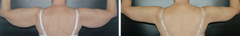 Arm Lift before 1149417