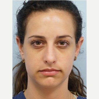 25-34 year old woman treated with Eye Bags Treatment before 3698495