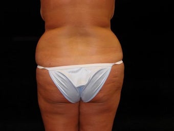 Brazilian Buttocks Lift before 246903