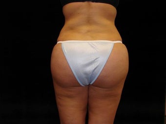 Brazilian Buttocks Lift after 246903