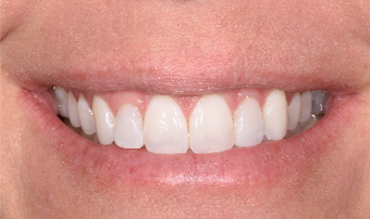 25-34 year old woman treated with Porcelain Veneers after 3735922