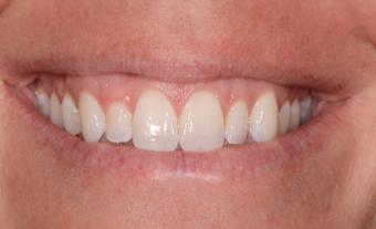 25-34 year old woman treated with Porcelain Veneers before 3735922