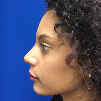 Non Surgical Nose Job | Liquid Rhinoplasty for this 32 Year Old Woman after 3295225