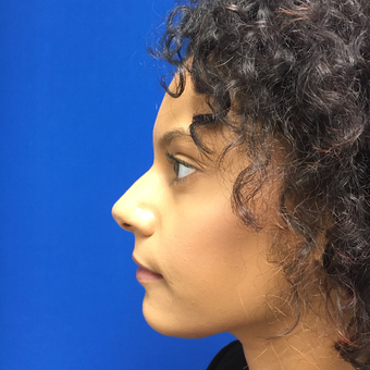 Non Surgical Nose Job | Liquid Rhinoplasty for this 32 Year Old Woman before 3295225