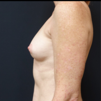35-44 year old woman treated with Mentor Breast Implants before 3529831