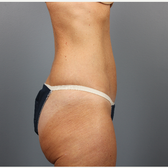 55-64 year old woman treated with CoolSculpting after 3507585