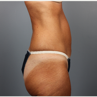 55-64 year old woman treated with CoolSculpting before 3507585