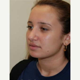 18-24 year old woman treated with Rhinoplasty after 3143520