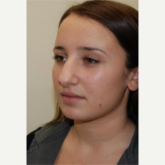 18-24 year old woman treated with Rhinoplasty before 3143520