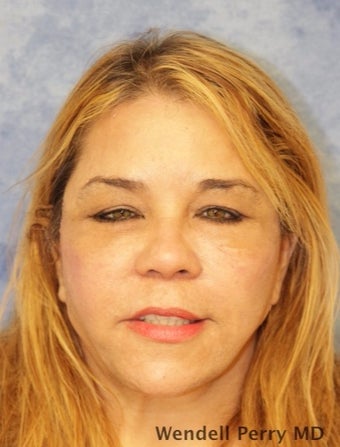 45-54 year old woman treated with Facelift after 3359450
