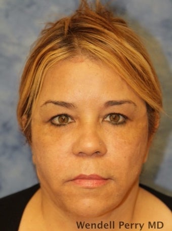 45-54 year old woman treated with Facelift before 3359450
