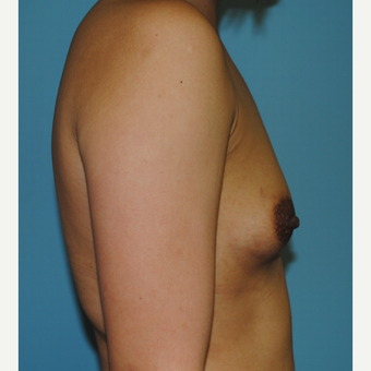 18-24 year old woman treated with Breast Augmentation before 3060920