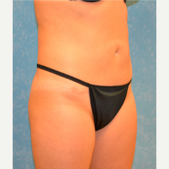 34 year self conscious about fullness in her abdomen after 3731643